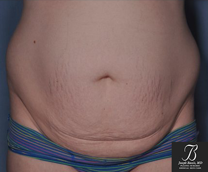 Tummy Tuck before photo