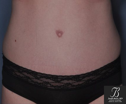 Tummy Tuck before photo