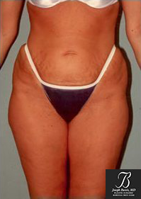 Liposuction Before photo