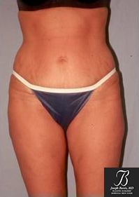 Liposuction After photo