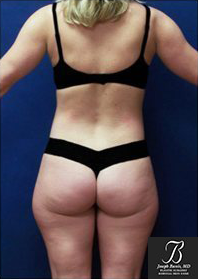 Liposuction before photo