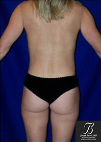Liposuction after photo