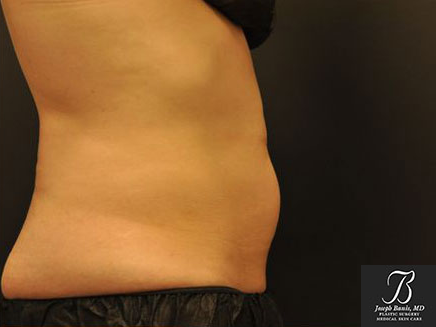 CoolSculpting before photo