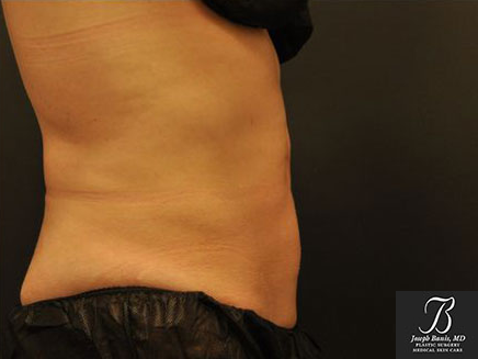 CoolSculpting after photo