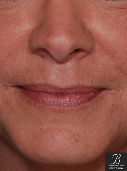 Dermal Fillers before photo