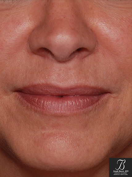 Dermal Fillers after photo