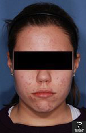 Teen Skin Care before photo