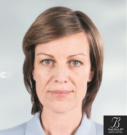 Sculptra Before