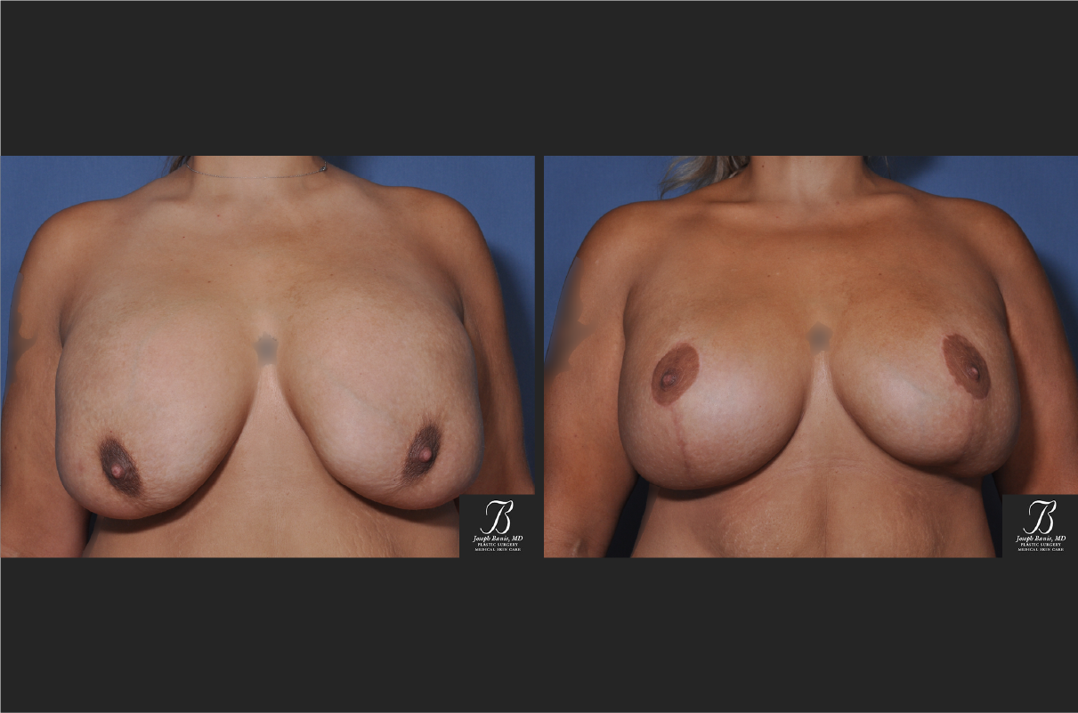 breast lift before and after