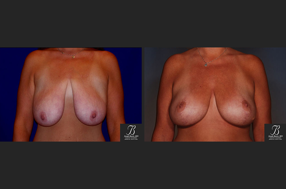 breast lift before and after