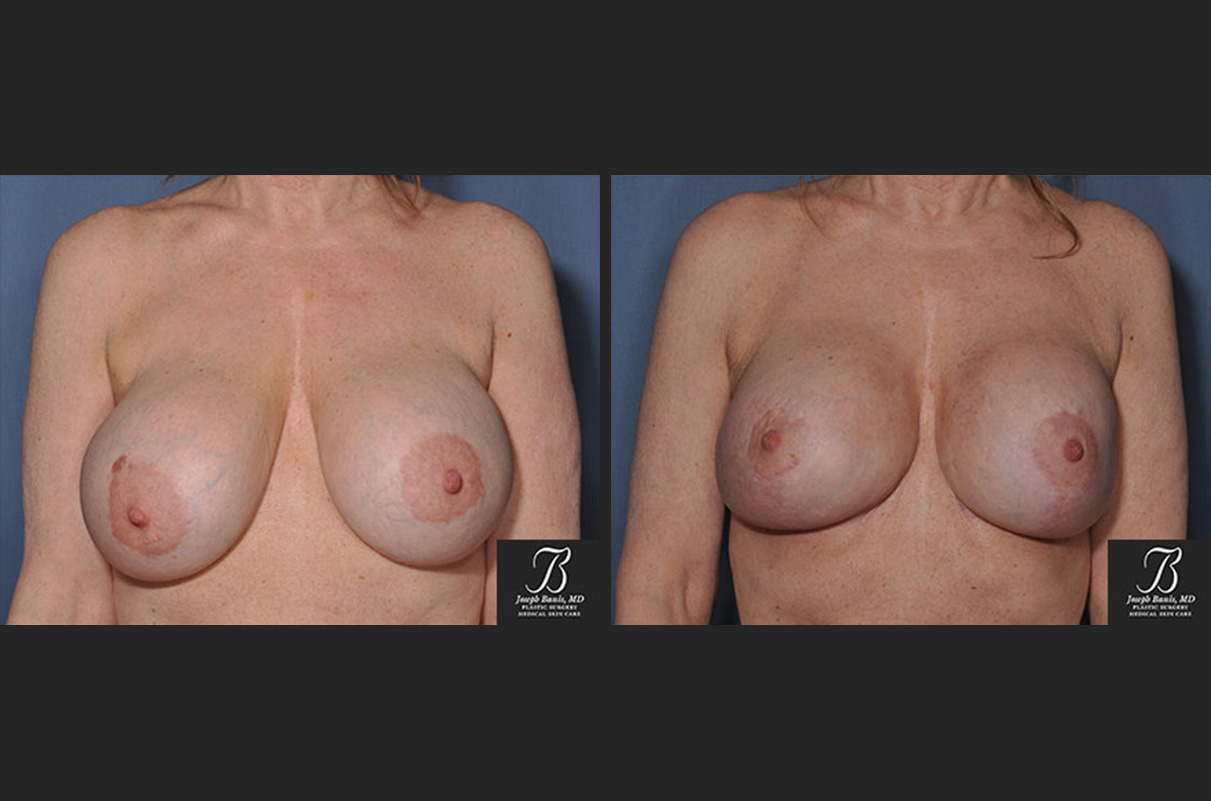 breast lift before and after