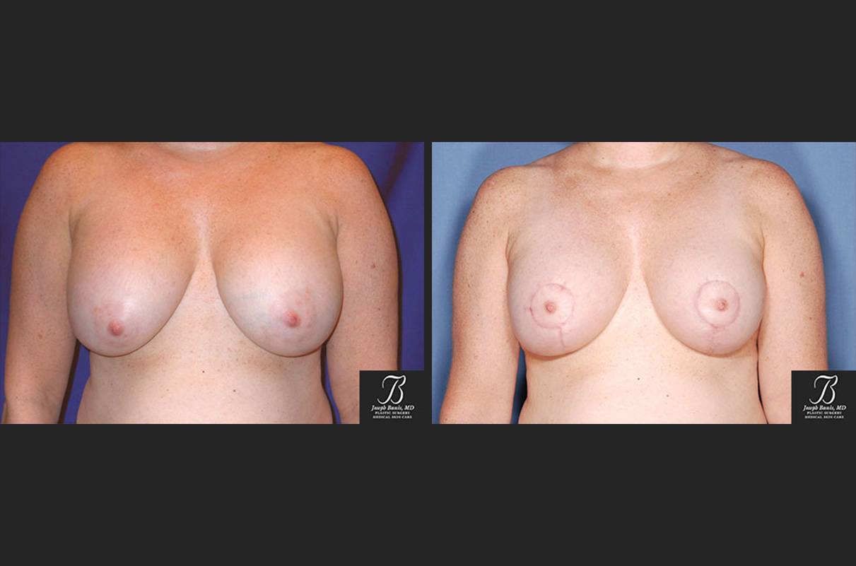 breast lift before and after