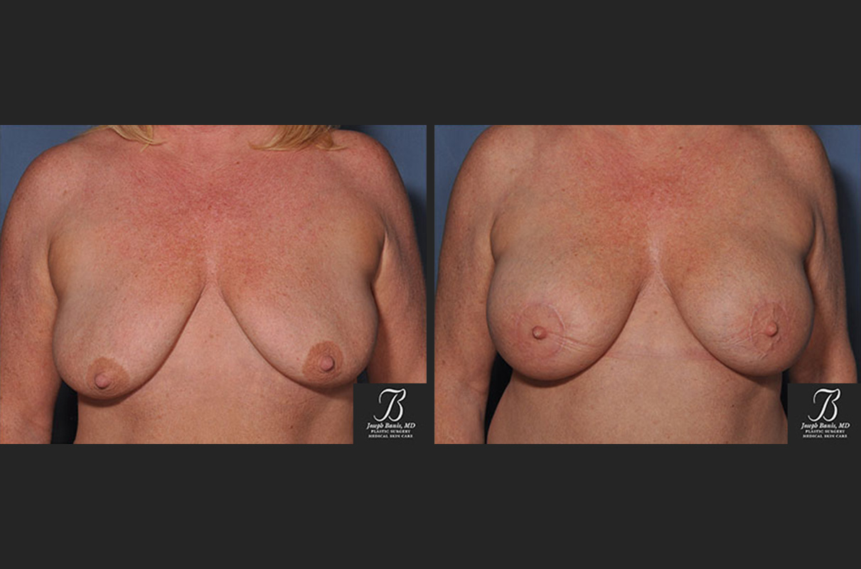 breast lift before and after