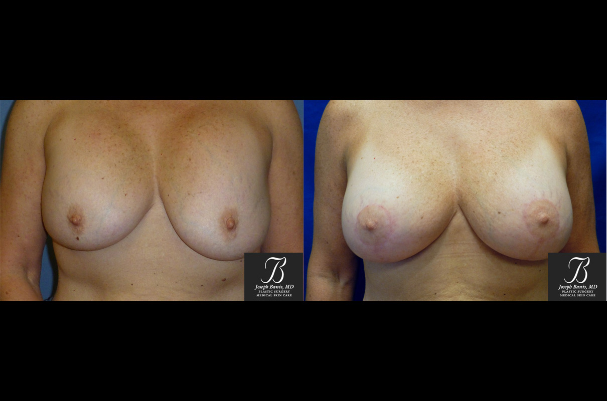 breast lift before and after