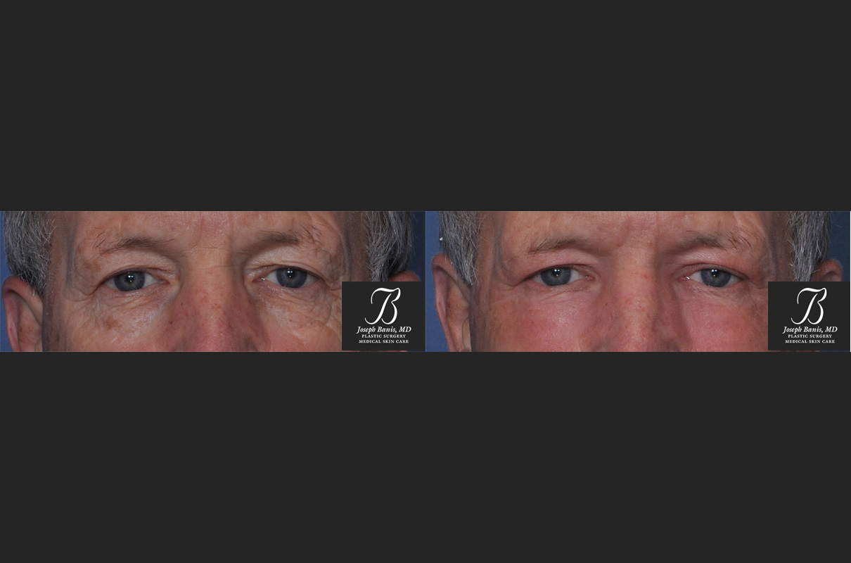 co2 laser resurfacing before and after