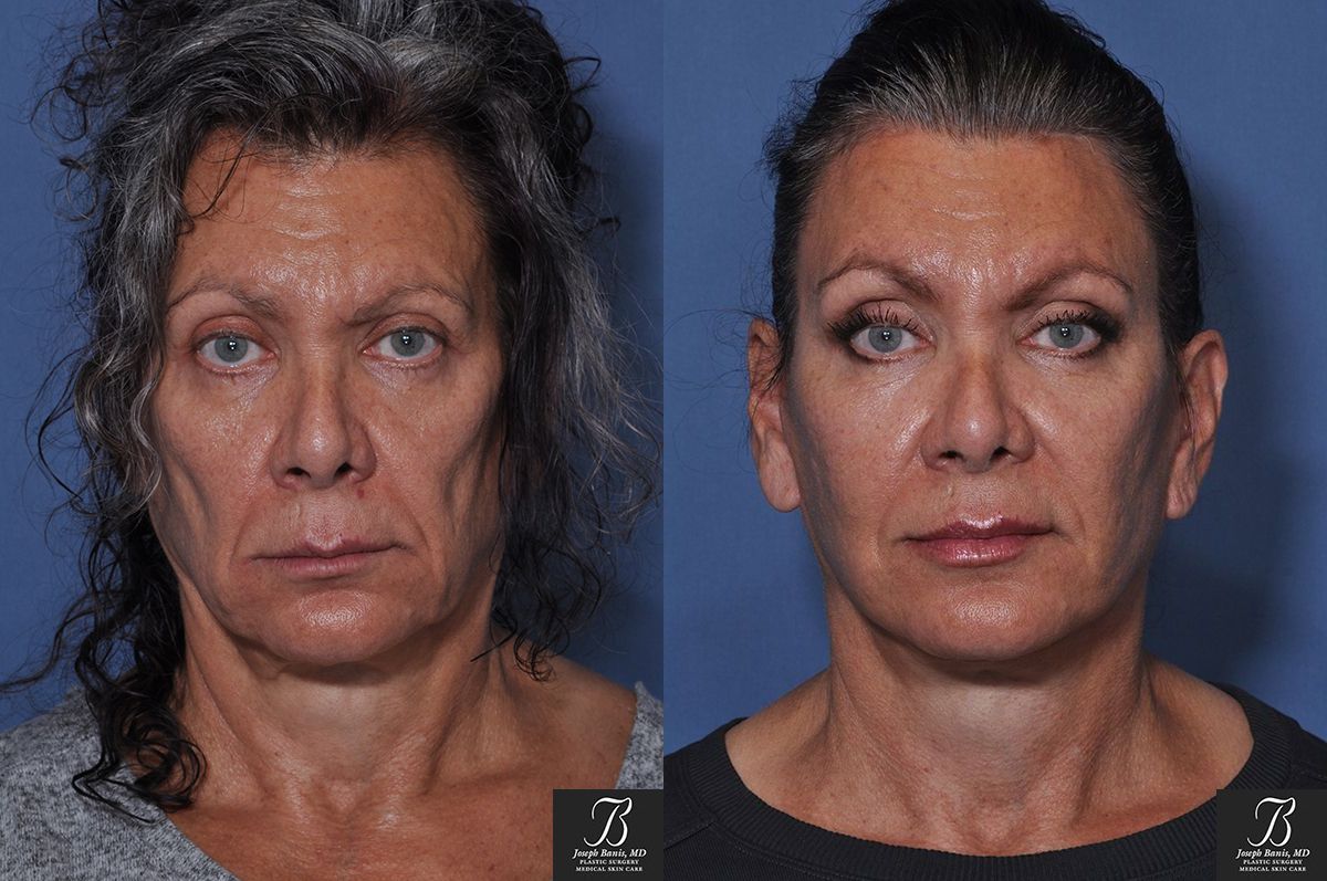 Face Lift Before and After Photo by Dr. Banis in Louisville, KY