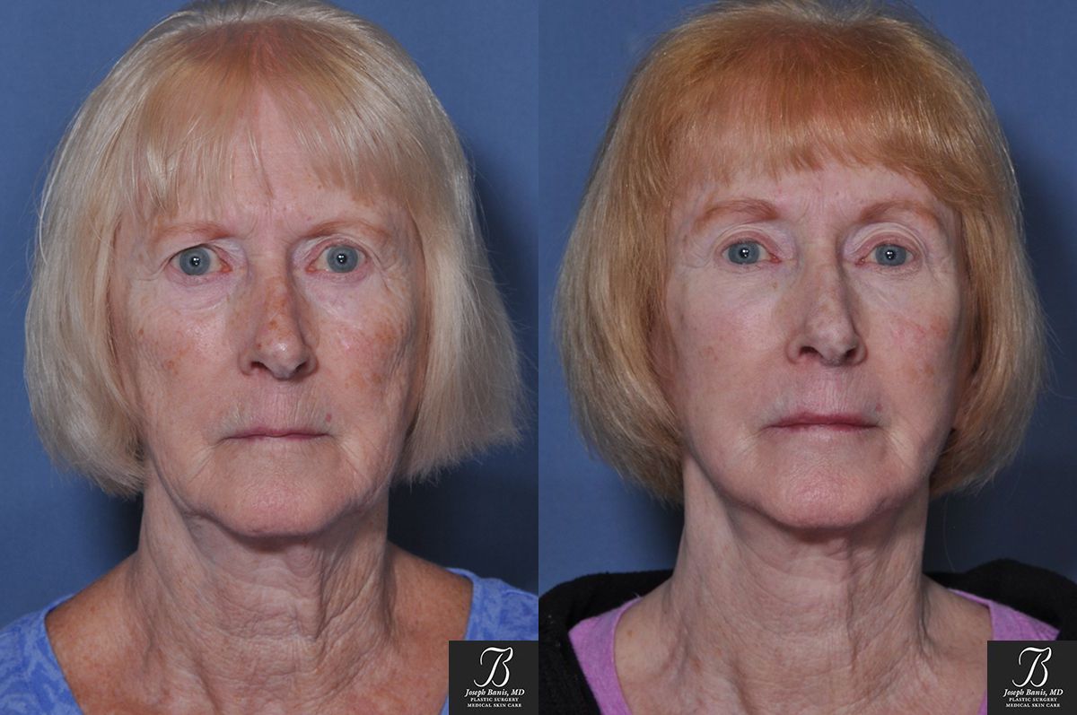 Face Lift Before and After Photo by Dr. Banis in Louisville, KY