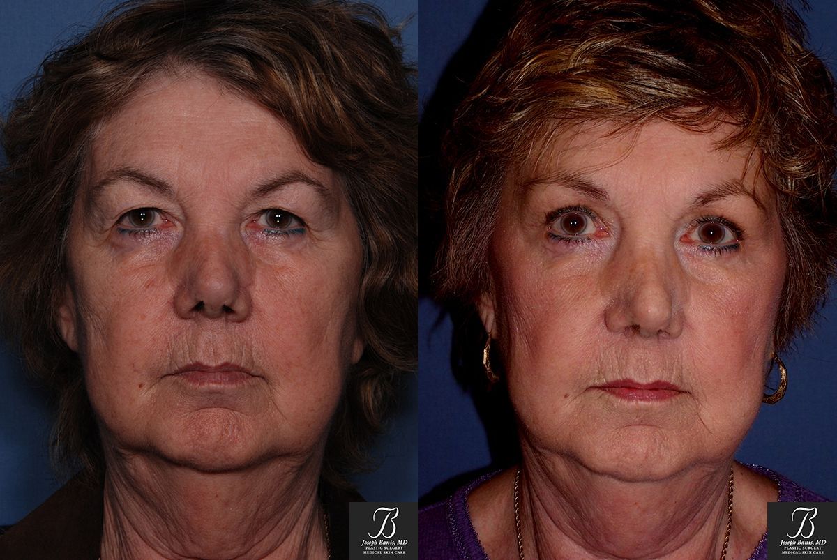 Brow Lift Before and After Photo by Dr. Banis in Louisville, KY