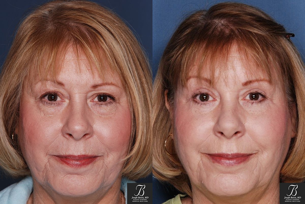 Brow Lift Before and After Photo by Dr. Banis in Louisville, KY