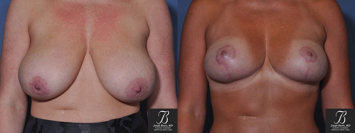 Mastopexy/Breast Lift Before and After Photo by Dr. Banis in Louisville, KY