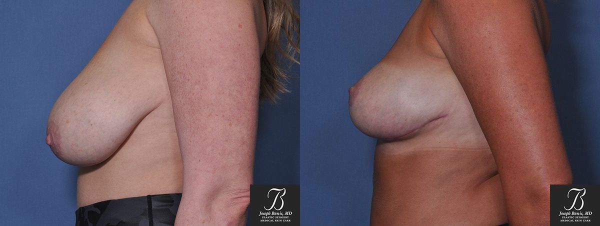 Mastopexy Before and After Photo by Dr. Banis in Louisville, KY