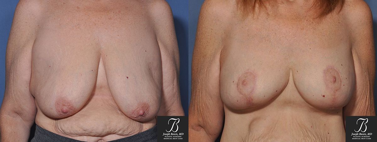 Mastopexy/Breast Lift Before and After Photo by Dr. Banis in Louisville, KY