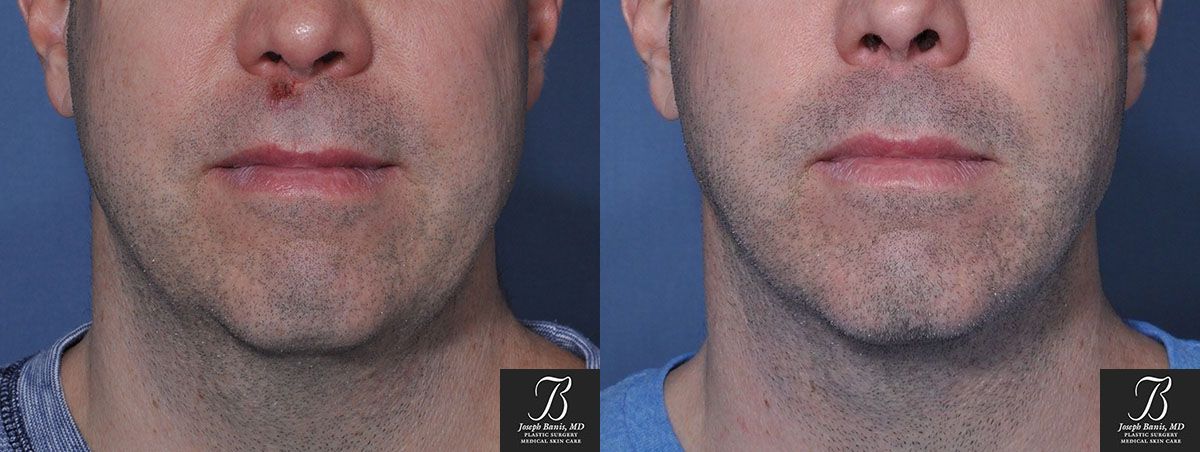 Liposuction Before and After Photo by Dr. Banis in Louisville, KY