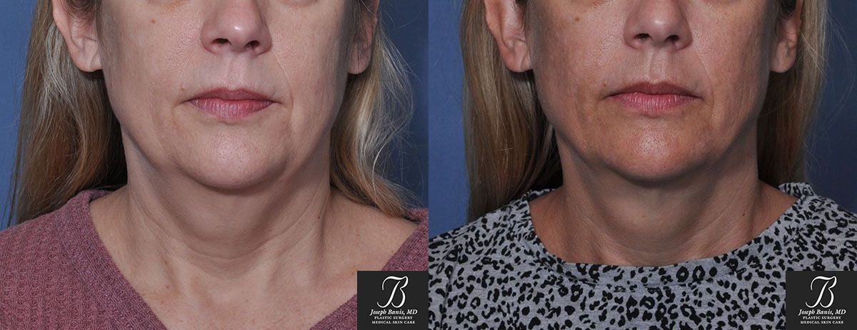 Liposuction Before and After Photo by Dr. Banis in Louisville, KY