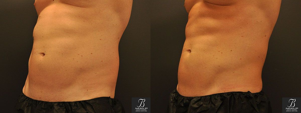 Coolsculpting Before and After photo by Dr. Joseph Banis in Louisville, KY