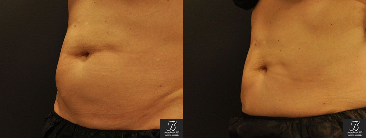Coolsculpting Before and After photo by Dr. Joseph Banis in Louisville, KY