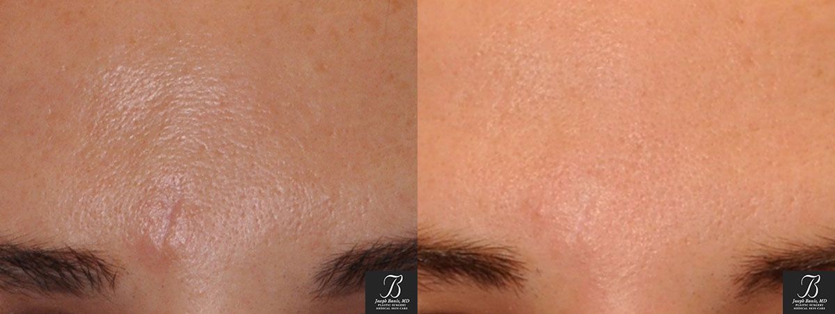 SkinPen Before and After photo by Dr. Joseph Banis in Louisville, KY