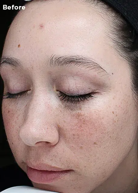 Vi Peel Before